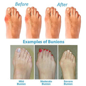 BunionRelief | Orthopedische Corrigerende Sandalen Dames
