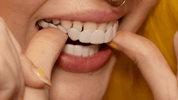 Direct een stralende glimlach met Snap on Smile Veneers 6