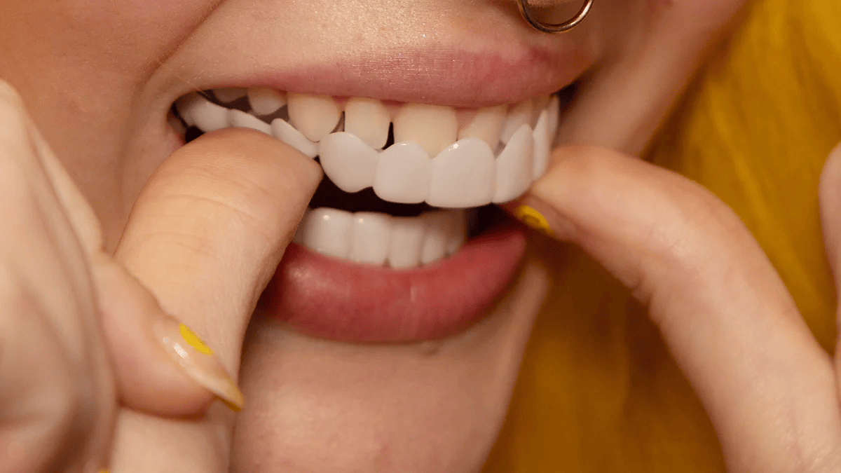 Direct een stralende glimlach met Snap on Smile Veneers 6