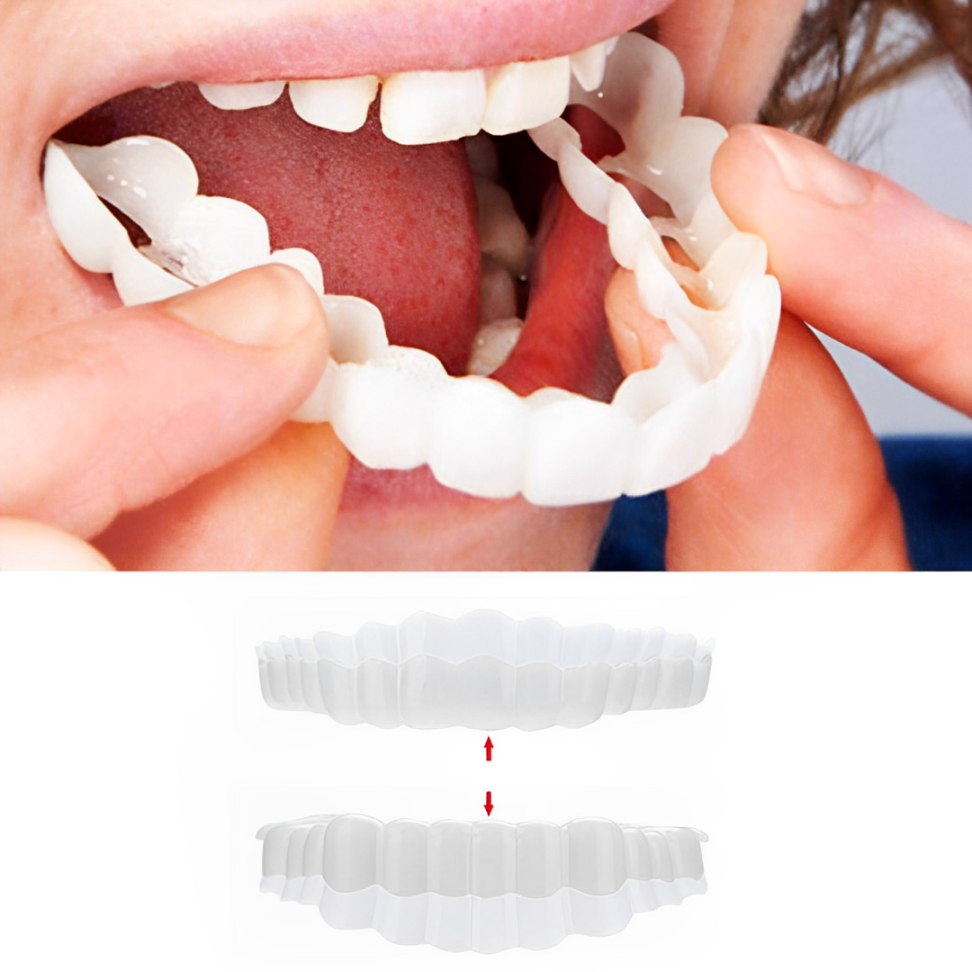 Smile Veneer (inclusief boven- en onderzijde) 0