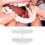 Smile Veneer (inclusief boven- en onderzijde) 0