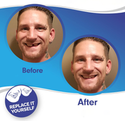 Smile Veneer (inclusief boven- en onderzijde) 1