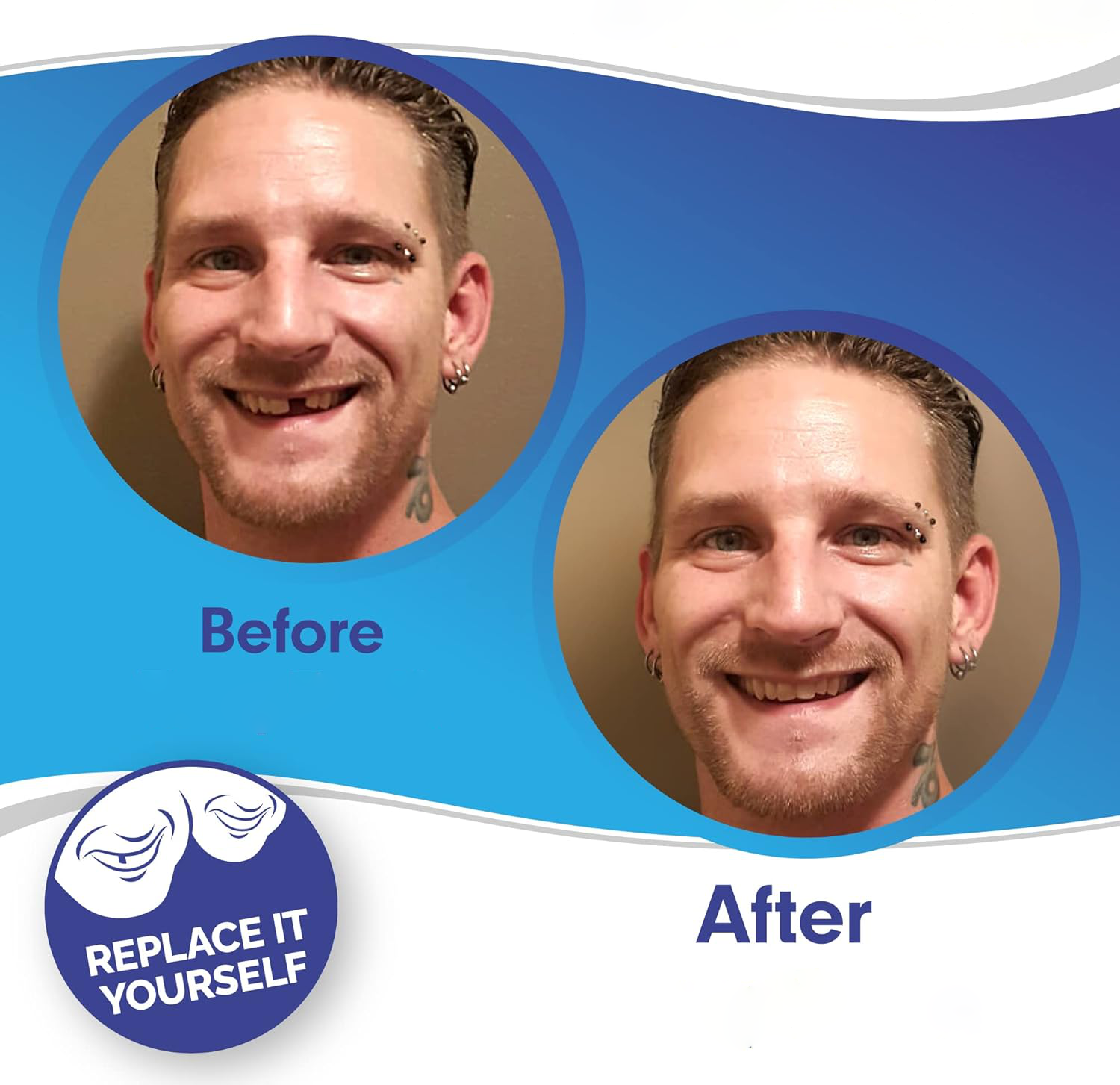 Smile Veneer (inclusief boven- en onderzijde) 1