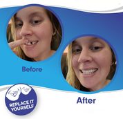 Smile Veneer (inclusief boven- en onderzijde) 2