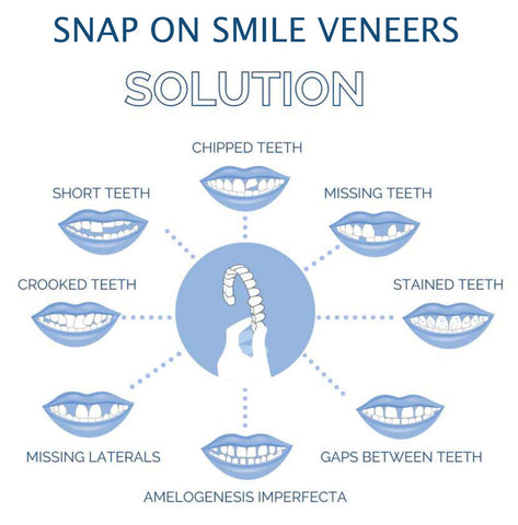 Smile Veneer (inclusief boven- en onderzijde) 5